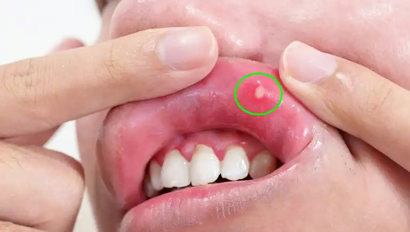 Vücut İçin Hayati Öneme Sahip 5 B Vitamini Eksikliği Belirtisi