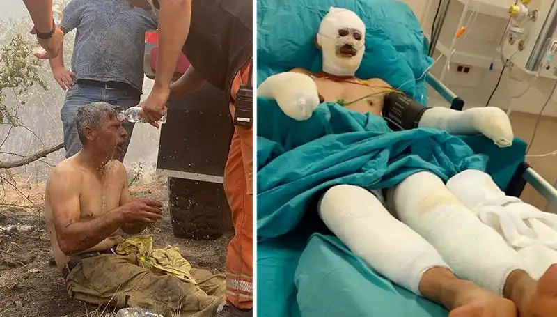Yanıyorum Feryadı ile Tedavi Altına Alınan Orman İşçisinin Durumu Gündem Oldu